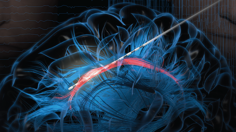 Illustration showing how an electrode was inserted into the cingulum bundle.